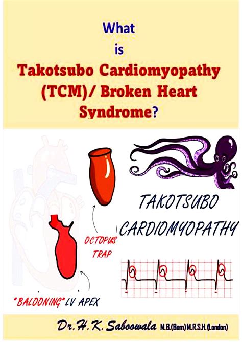 What Is Takotsubo Stress Cardiomyopathy Tcm Broken Heart Syndrome