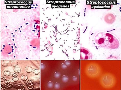 Streptococcus Pneumoniae Gram Stain : Streptococcus pneumoniae in sputum - Stock Image - B236 ...