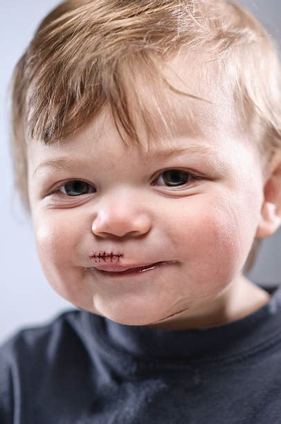 110+ Infant Sutures Stock Photos, Pictures & Royalty-Free Images - iStock