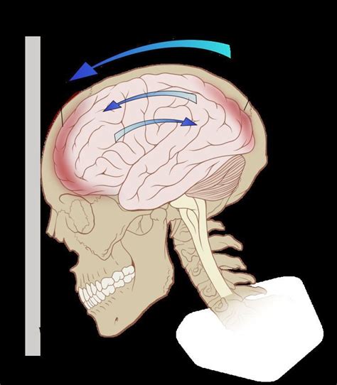 Coup contrecoup injury - Alchetron, The Free Social Encyclopedia