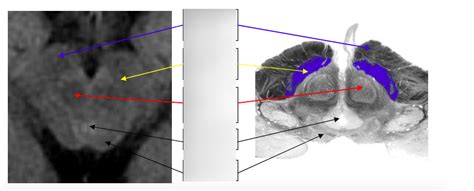 Midbrain Level Axial Flair Mri Diagram Quizlet