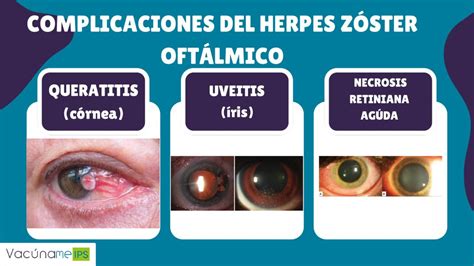 Todo Lo Que Debes Saber Sobre El Herpes Z Ster Y C Mo Prevenirlo Con La