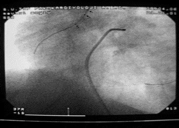 Removal Of Fractured Balloon Catheter Using Another Balloon Inflation