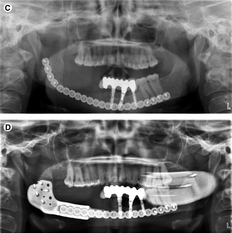 Customized Repair Of Fractured Mandibular Reconstruction Plates