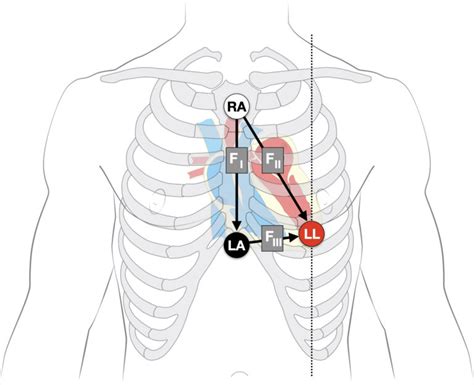 Epsilon Wave • LITFL Medical Blog • ECG Library Basics