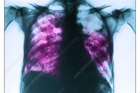 Pneumocystis Pneumonia Pcp X Ray Stock Image C038 9056 Science Photo Library