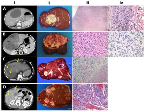 Liver Spots Vs Skin Cancer