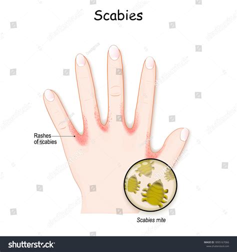 Scabies Mite Humans Hand Skin Rashes Stock Vector (Royalty Free