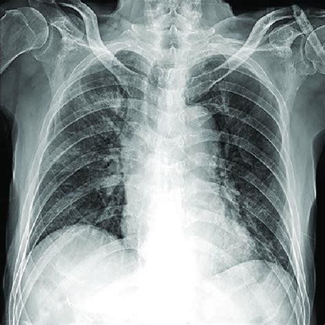 Anteroposterior Chest Radiograph Obtained On March 26 2020 Hospital