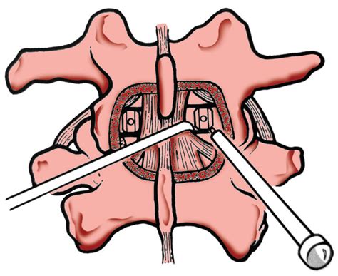 The New Lumbar Spinal Fusion Technique Minimally Invasive Trans Psoas