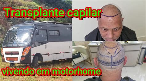 Transplante Capilar Vivendo Em Um Motorhome Youtube