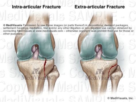 Intra Articular Fractures Explained