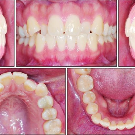 Pdf Correction Of Palatally Displaced Maxillary Lateral Incisors