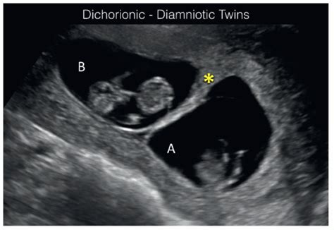 Multiple Pregnancies In The First Trimester Radiology Key