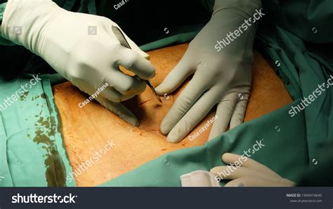 Surgeon Performing Incision On Abdomen Stock Photo