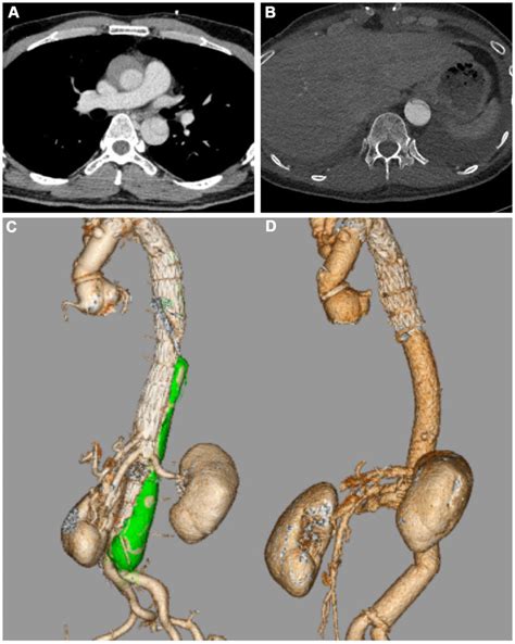 A Computed Tomography Ct At The Onset Of Acute Aortic Dissection