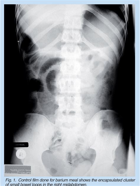 Figure 1 from Right paraduodenal hernia | Semantic Scholar