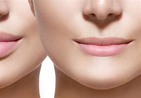 Dissolving Lip Fillers A Comprehensive Guide