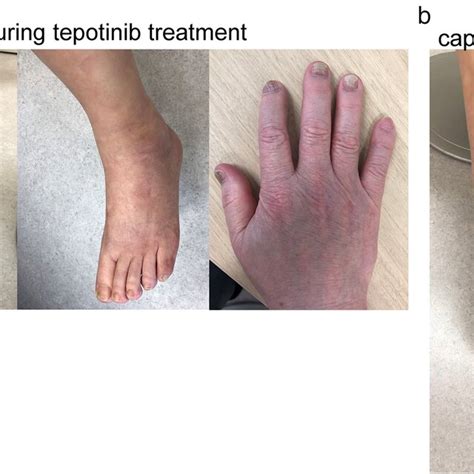 (a) Peripheral edema in the lower legs and strong mark on the socks,... | Download Scientific ...