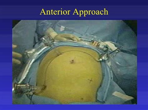 Laparoscopic Colon Resection Anterior Approach