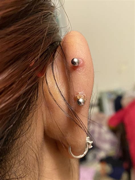 Infected Ear Cartilage Piercing