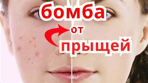 Как Убрать Угри Прыщи и Постакне ? Маски для лица от Угрей ,Чёрных ...