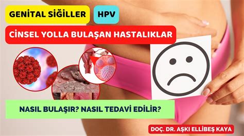 Genital Siğiller HPV Cinsel Yolla Bulaşan Hastalıklar Nasıl bulaşır