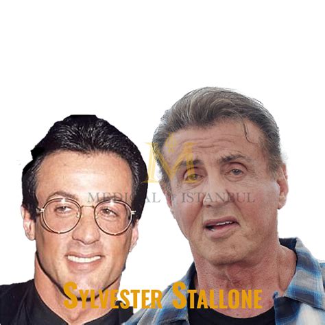 Sylvester Stallone Hair Transplant A Journey of Transform