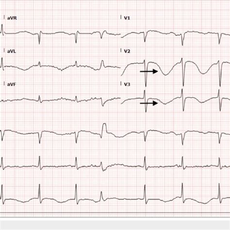 Admission ECG QTc At 757 Ms Deeply Inverted Twaves On V2 And V3 And