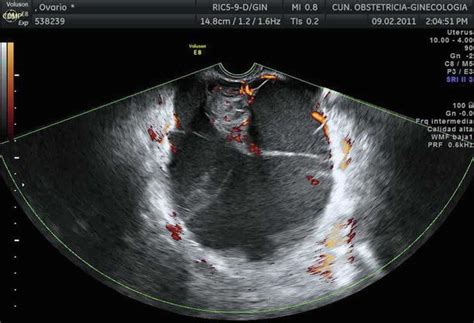 Malignant Ovarian Tumors Serousmucinousendometrioidclear Cell