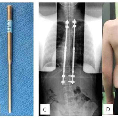 Radiographs Of Patient 23 With Idiopathic Early Onset Scoliosis