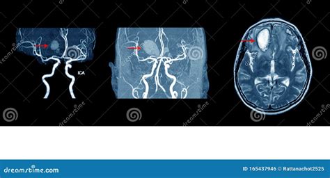 Mra And Mrv Of Brain Stock Photo Image Of Hospital