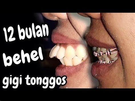 Bulan Perawatan Behel Gigi Maju Tonggos Jadi Rapi Dokter Gigi Jogja