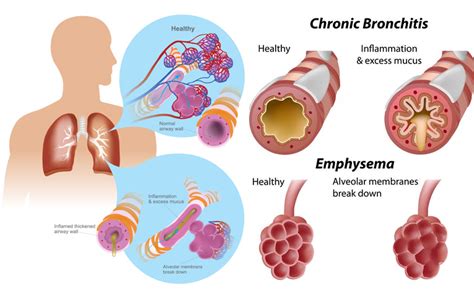 Risk factors of COPD Archives - MedicoInfo