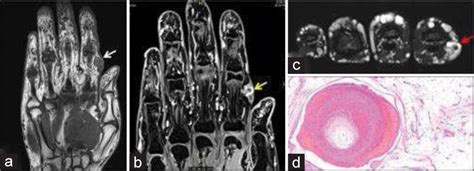 Common Soft Tissue Tumors Involving The Hand With Histopathological