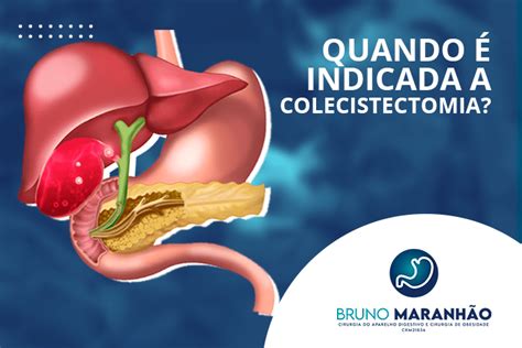 Quando Indicada A Colecistectomia Dr Bruno Maranh O Cirurgia