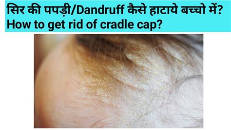 सिर की पपड़ी Dandruff कैसे हाटाये बच्चो में How To Get Rid Of Cradle