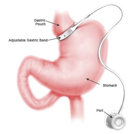 Gastric Band Surgery in Mexico | Gastric Sleeve