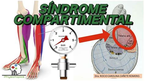 S Ndrome Compartimental M Elizabeth Azer Do B Udocz