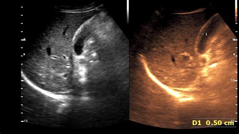 Adenomyomatosis Gall Bladder Rokitansky Aschoff Sinuses Youtube