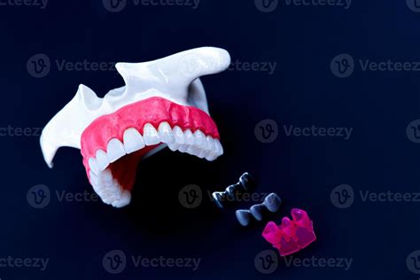 Tooth implant and crown installation process 11258914 Stock Photo at ...