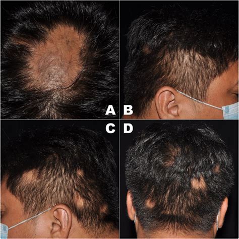 Clinical Presentation Of Alopecia Areata On A The Vertex B The Download Scientific Diagram