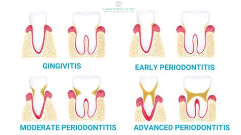 Stages Of Periodontal Disease How Gum Disease Is Treated