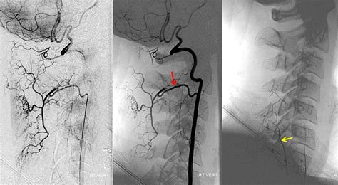 Ascending Cervical Artery