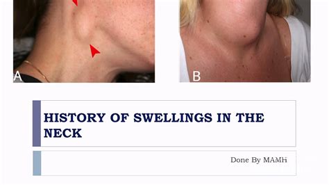 History Of the Neck Swelling & Lump, CA Surgery - YouTube