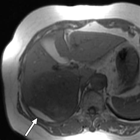 Hepatocellular Carcinoma Variants Radiologic Pathologic Correlation Ajr