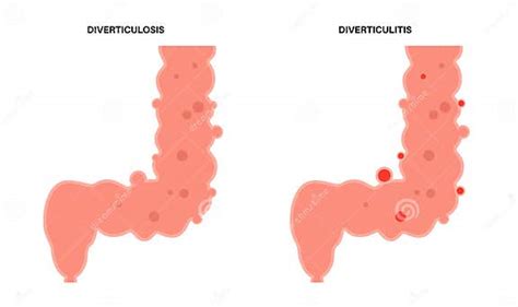 Diverticulitis And Diverticulosis Stock Vector Illustration Of