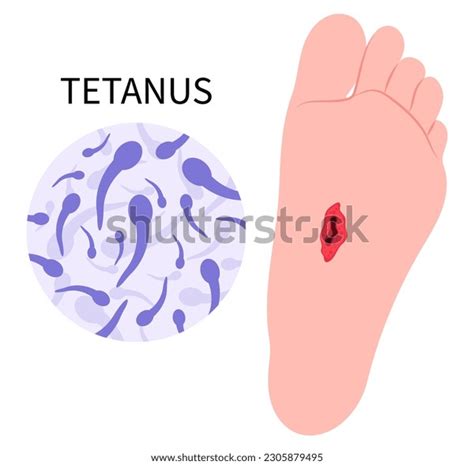 Tetanus Vaccine: Over 493 Royalty-Free Licensable Stock Vectors ...