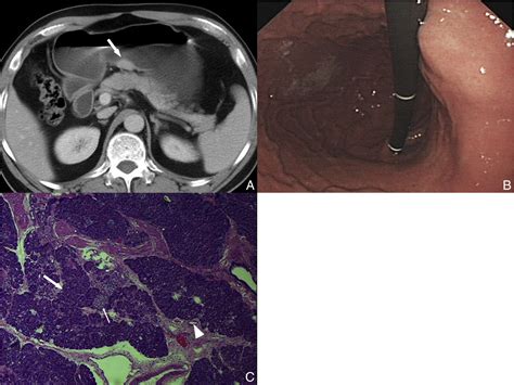 Upper Gastrointestinal Tract Heterotopic Pancreas Findings From Ct And