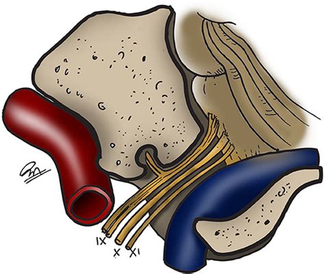 Frontiers Microsurgical Anatomy Of The Jugular Foramen Applied To